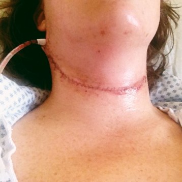 36 stitches and a drain!