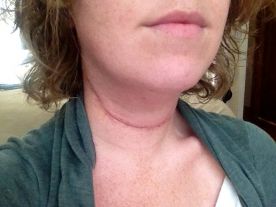 The first day I really noticed the swelling going down.