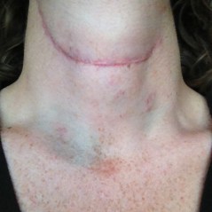 Bruising that lasted for over 2 weeks from the biopsies. (looked like awkward hickeys for a bit)